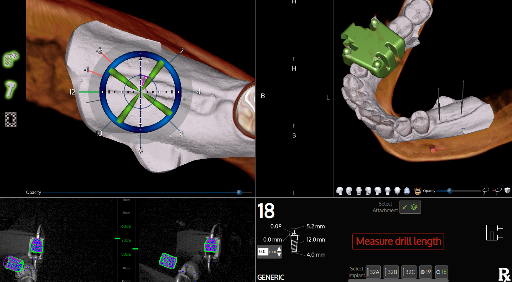 X-Guide live navigation display showing a planned implant position alongside three-dimensional dental anatomy